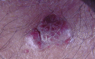 Hemangioma, close-up